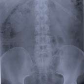 Radiografía de columna completa 30 x 90 (escoliograma)