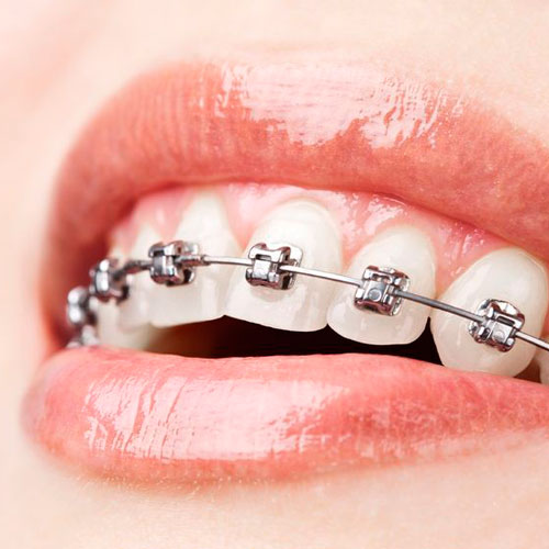 Ortodoncia Fija con Brackets Metálicos en Vigo