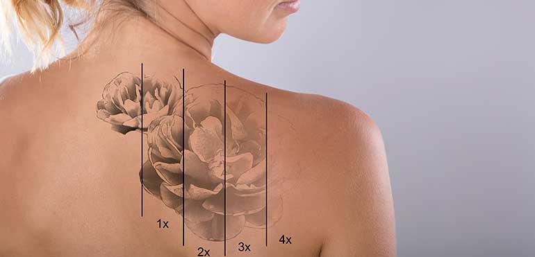 Eliminar tatuajes: dudas y consejos