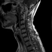 Resonancia Magnética Cervical Resonancia Magnética Cervical